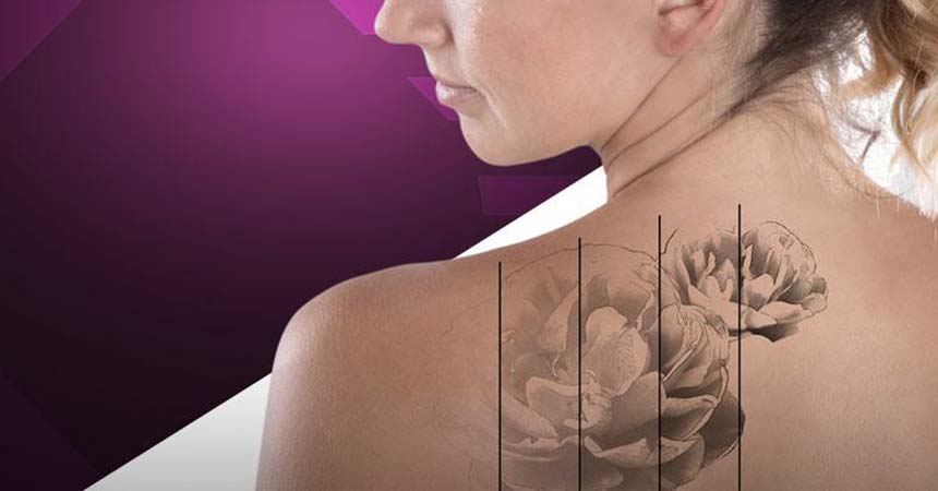 Tattoo Removal | Candela Medical
