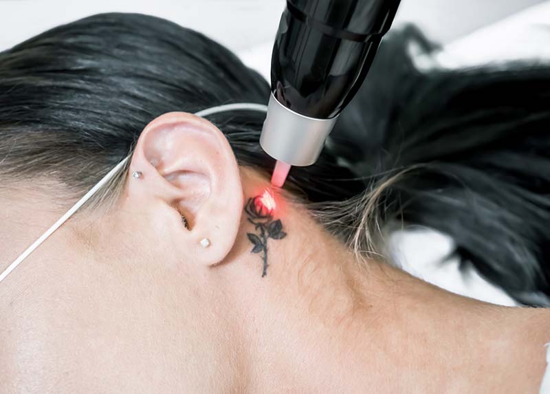 Tattoo removal treatment
