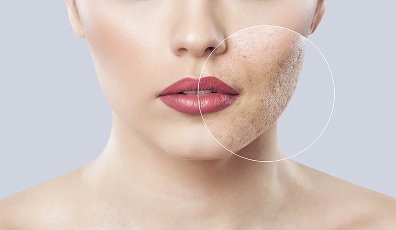 laser skin resurfacing for acne scars