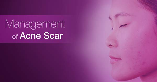 Management of Acne Scar