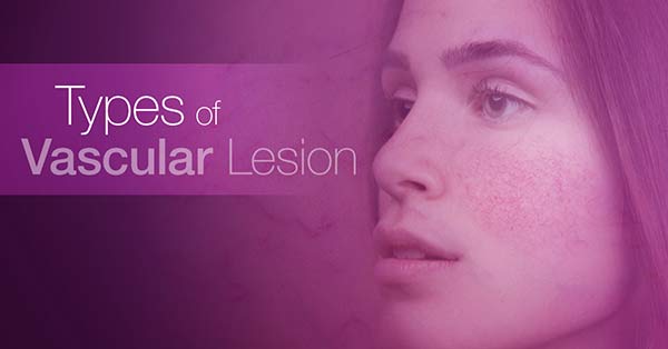 Types of Vascular Lesion