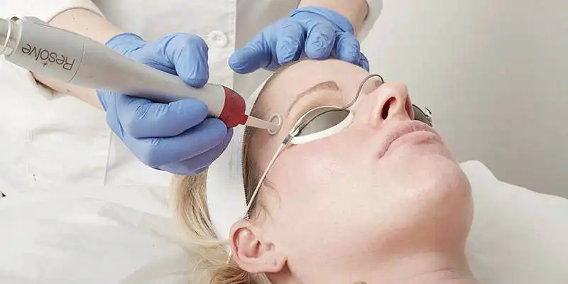 PicoWay facial treatment