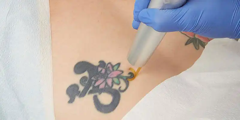 Picoway laser tattoo removal