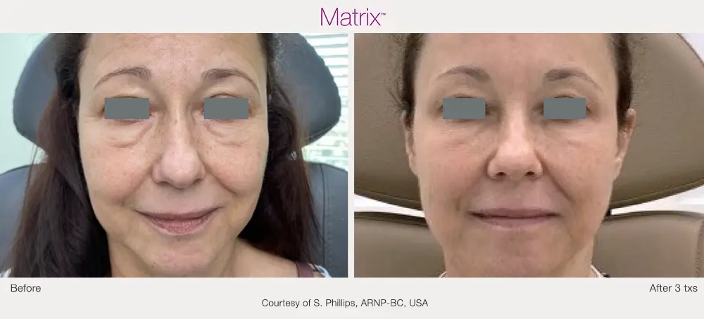Matrix radiofrequency facial treatment