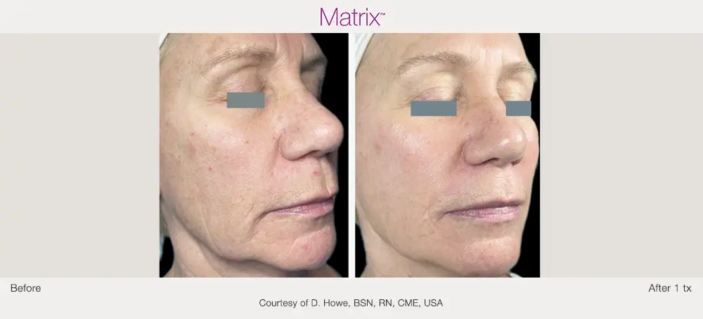 Matrix radiofrequency facial treatment