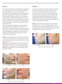 Laser-Assisted Acne Therapy