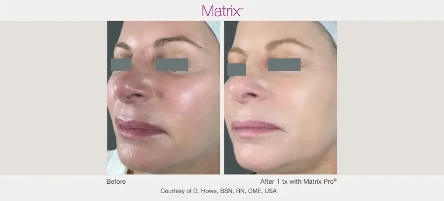 Matrix RF microneedling facial treatment