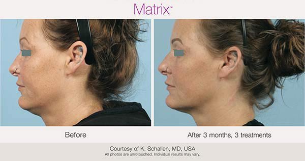 Matrix Pro RF Microneedling treatment before and after photos