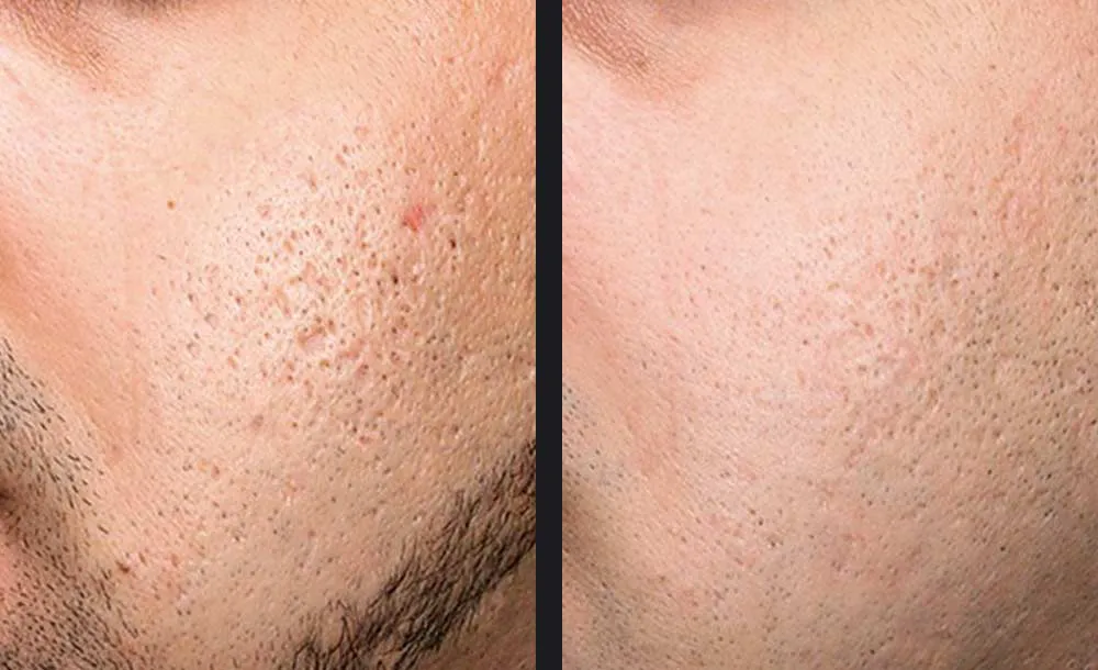 Exceed acne scars treatment