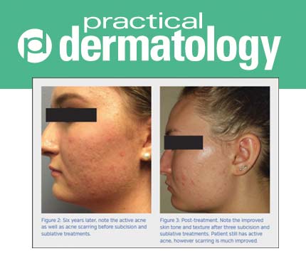 Subcision-Plus-Sublative-Technologies-to-Treat-Acne-Scars