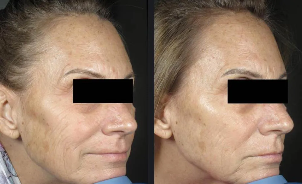 PicoWay Resolve skin rejuvenation treatment