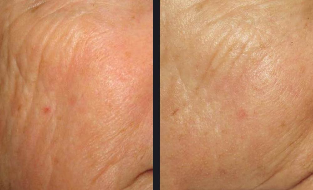 Picoway Resolve skin rejuvenation treatment