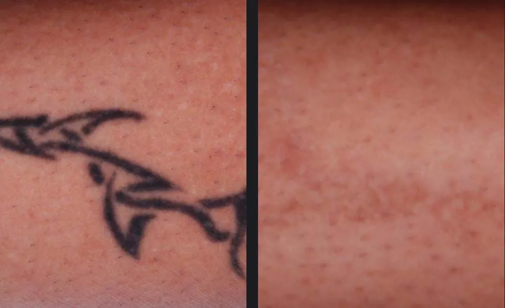 PicoWay Laser Tattoo Removal Specialist Near Me in Saint Clair Shores MI