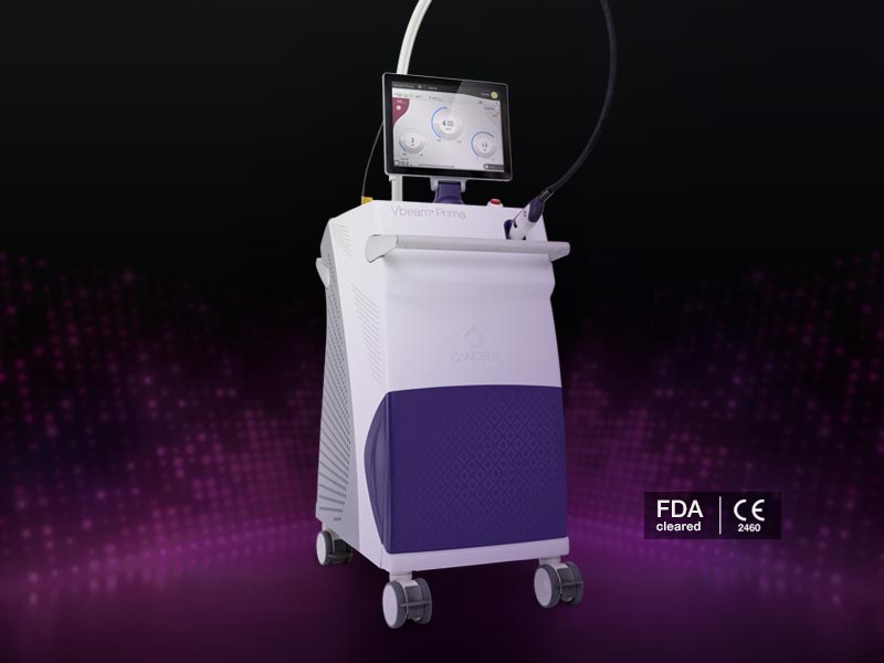 Vbeam Prima pulsed-dye laser (PDL) system
