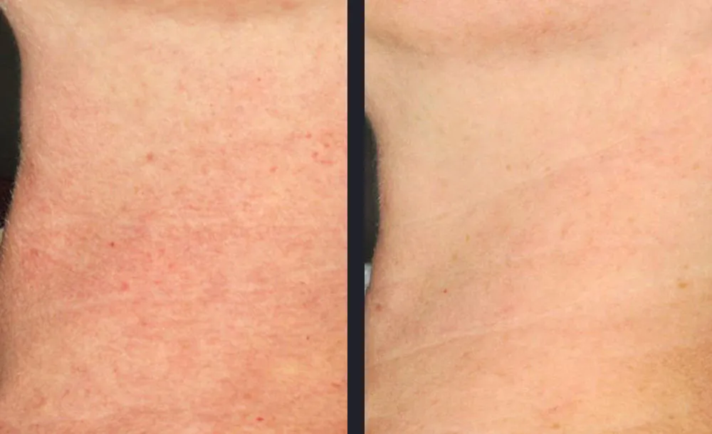 Vbeam Prima before & after treatment