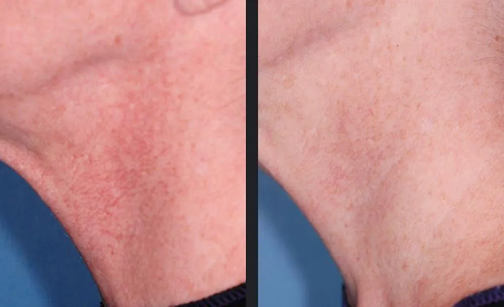 Vbeam Prima before & after treatment