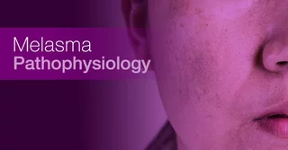 Melasma Pathophysiology